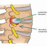 Physiotherapy Exercises For lumbar disc herniation